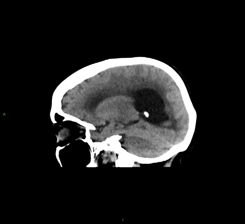 Cerebellar hemorrhage (Radiopaedia 58793-66027 C 34).jpg