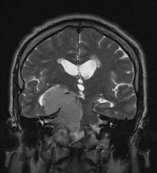 File:Cerebellopontine angle meningioma (Radiopaedia 24459-24764 Coronal T2 12).jpg