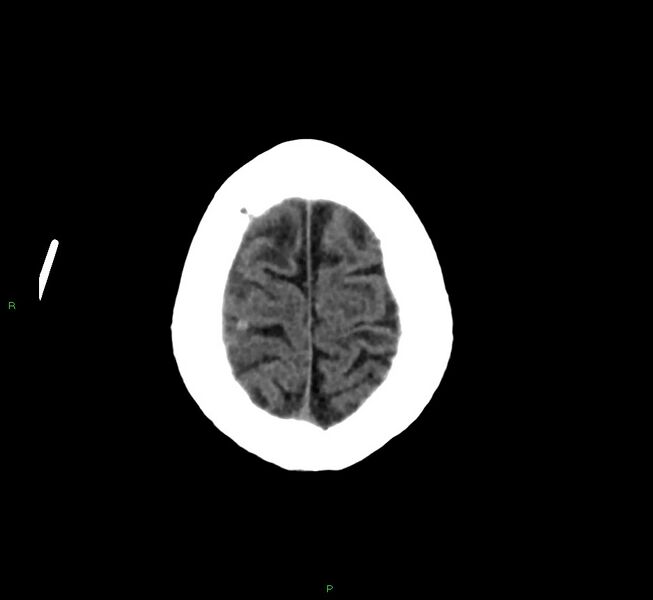 File:Cerebral amyloid angiopathy-associated lobar intracerebral hemorrhage (Radiopaedia 58376-65513 Axial non-contrast 8).jpg