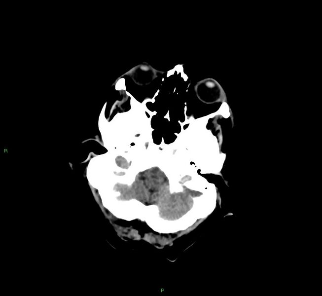 File:Cerebral amyloid angiopathy-associated lobar intracerebral hemorrhage (Radiopaedia 58377-65514 Axial non-contrast 41).jpg