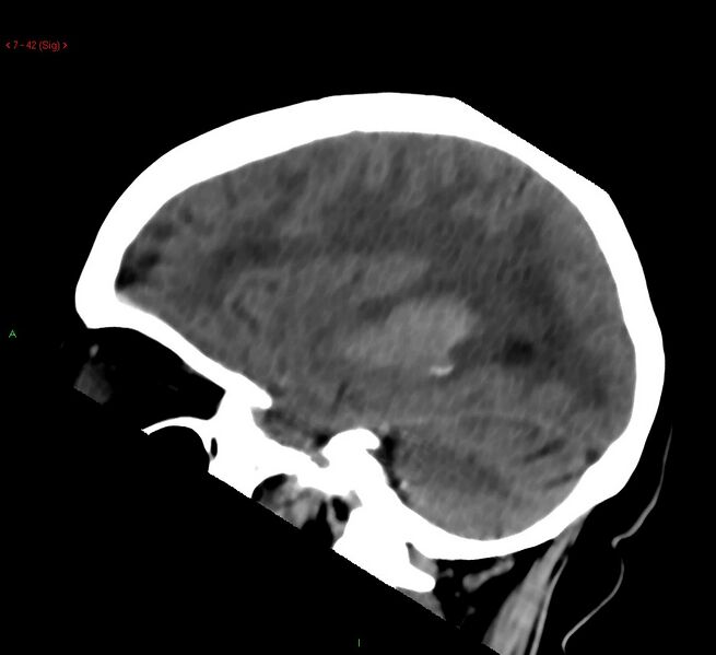 File:Cerebral amyloid angiopathy-associated lobar intracerebral hemorrhage (Radiopaedia 58378-65518 C 42).jpg
