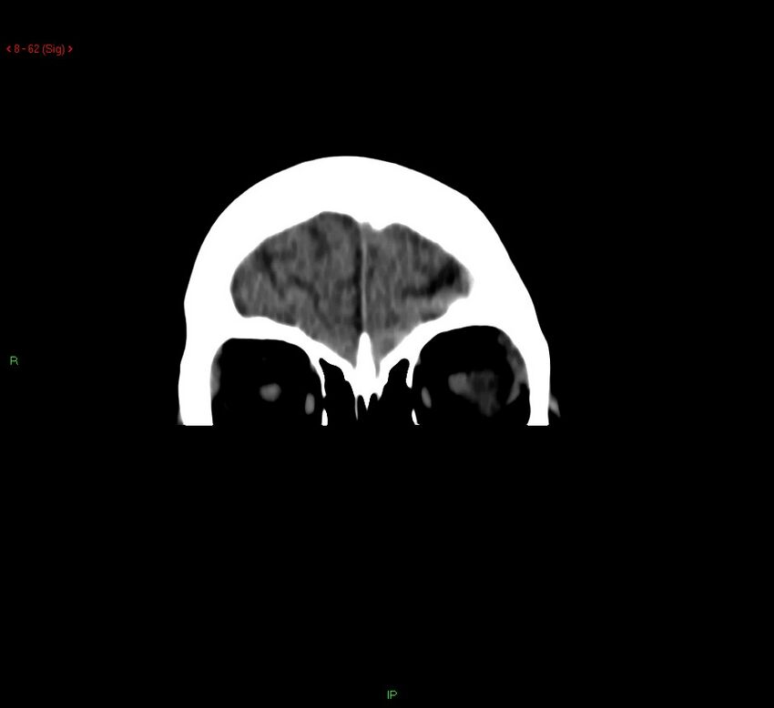 Cerebral amyloid angiopathy-associated lobar intracerebral hemorrhage (Radiopaedia 58378-65518 Coronal non-contrast 62).jpg