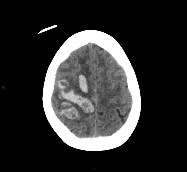 File:Cerebral amyloid angiopathy-associated lobar intracerebral hemorrhage (Radiopaedia 58566-65730 Axial non-contrast 12).jpg