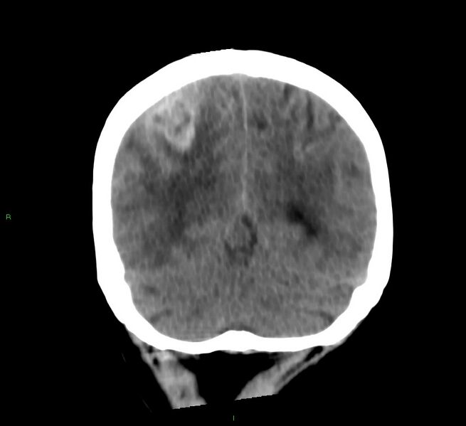 File:Cerebral amyloid angiopathy-associated lobar intracerebral hemorrhage (Radiopaedia 58566-65730 Coronal non-contrast 22).jpg