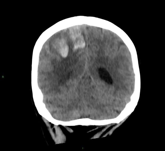 File:Cerebral amyloid angiopathy-associated lobar intracerebral hemorrhage (Radiopaedia 58566-65730 Coronal non-contrast 24).jpg
