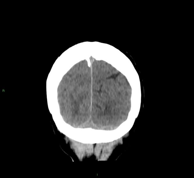 File:Cerebral amyloid angiopathy-associated lobar intracerebral hemorrhage (Radiopaedia 58756-65977 Coronal non-contrast 12).jpg