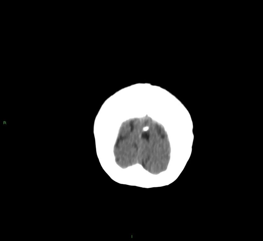 Cerebral amyloid angiopathy-associated lobar intracerebral hemorrhage (Radiopaedia 58757-65978 Coronal non-contrast 8).jpg