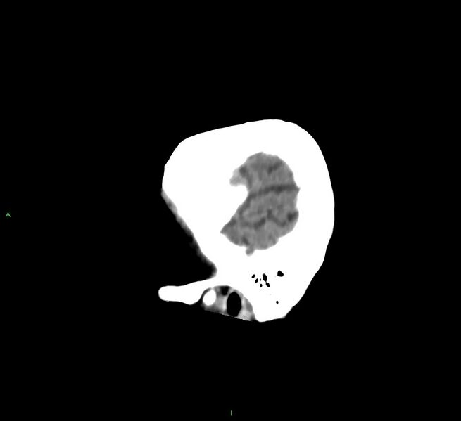 File:Cerebral amyloid angiopathy-associated lobar intracerebral hemorrhage (Radiopaedia 58758-65980 C 49).jpg