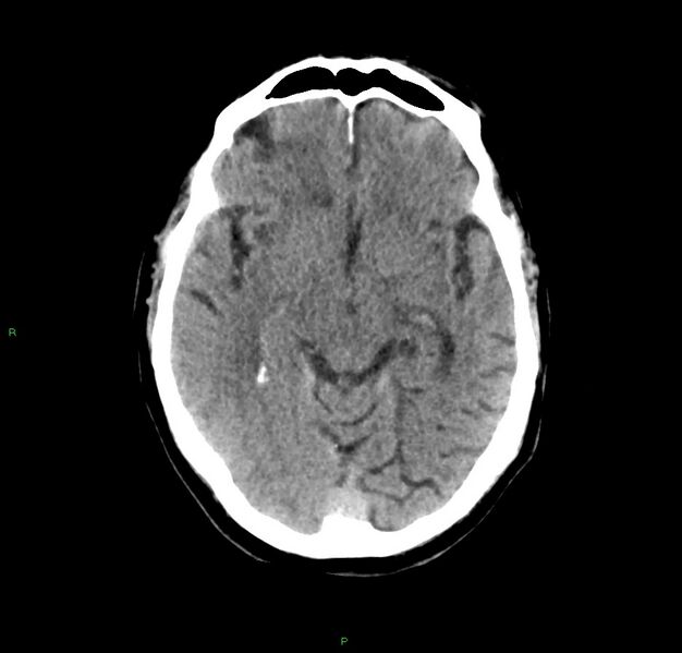 File:Cerebral amyloid angiopathy-associated lobar intracerebral hemorrhage (Radiopaedia 59356-66716 Axial non-contrast 28).jpg