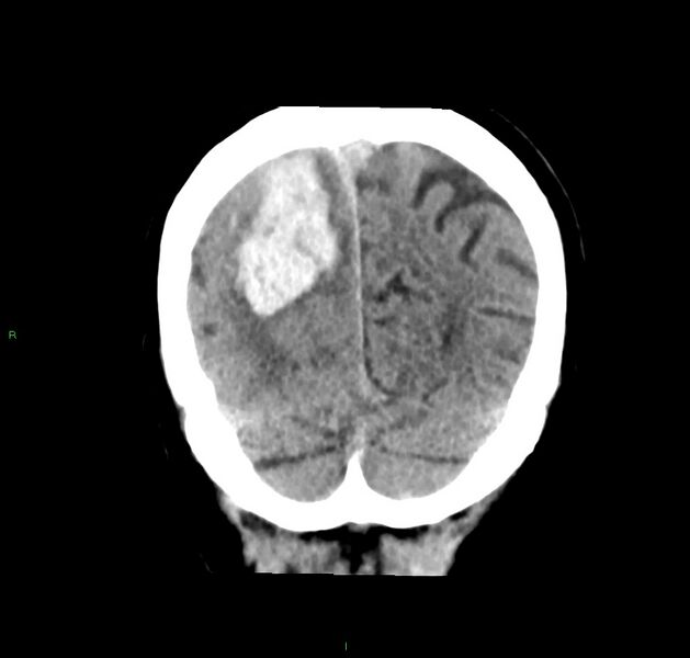File:Cerebral amyloid angiopathy-associated lobar intracerebral hemorrhage (Radiopaedia 59356-66716 Coronal non-contrast 15).jpg