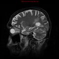 Cerebral and orbital tuberculomas (Radiopaedia 13308-13311 Sagittal T2 6).jpg