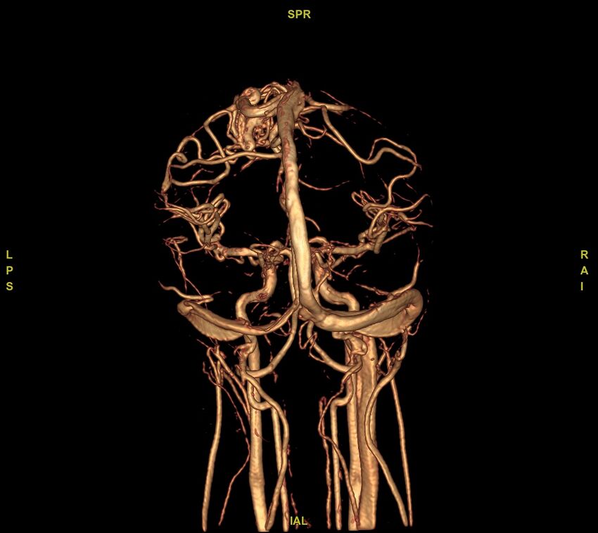 Cerebral arteriovenous malformation (Radiopaedia 61964-70029 VRT 15).jpg