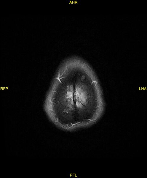 File:Cerebral autosomal dominant arteriopathy with subcortical infarcts and leukoencephalopathy (CADASIL) (Radiopaedia 86108-102054 Axial FLAIR 29).jpg