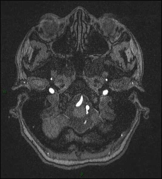 File:Cerebral fat embolism (Radiopaedia 35022-36525 Axial TOF 20).jpg