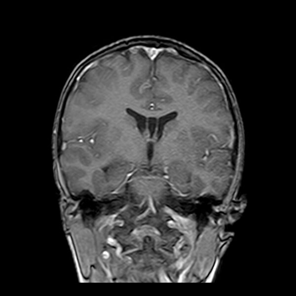 File:Cerebral tuberculoma (Radiopaedia 41152-43932 Coronal T1 C+ 9).jpg