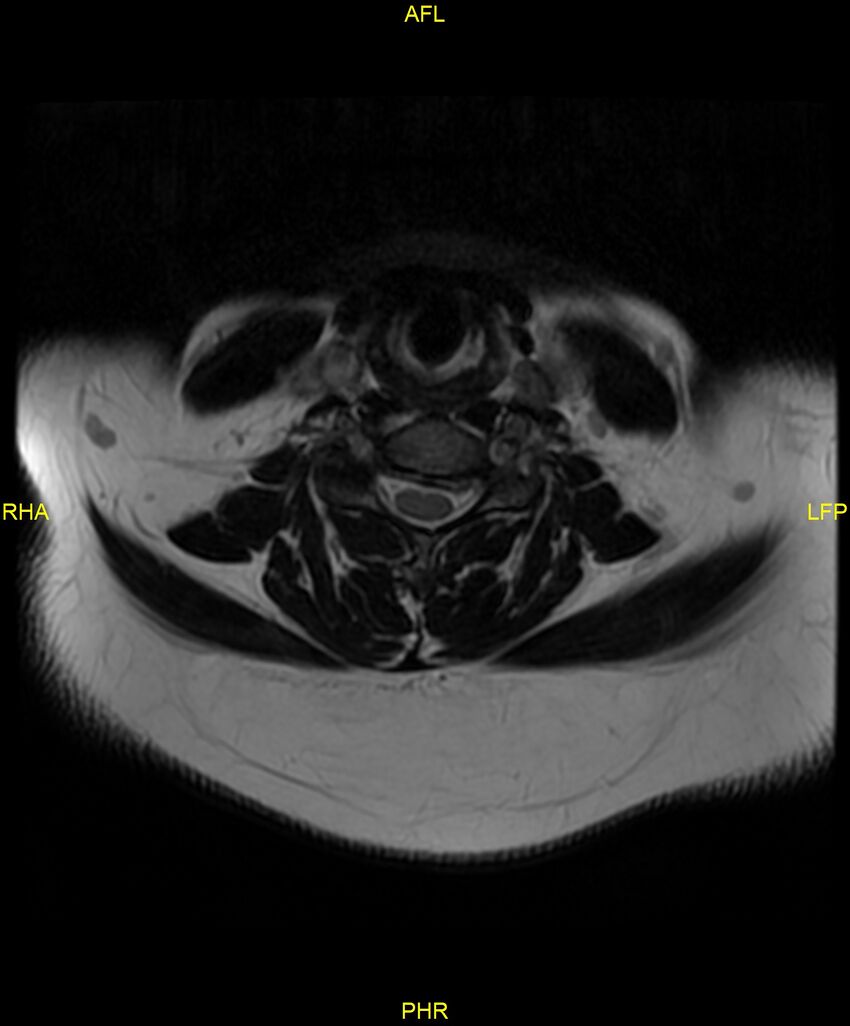 Cervical disc protrusion (Radiopaedia 87147-103415 Axial T2 31).jpg