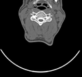 Cervical dural CSF leak on MRI and CT treated by blood patch (Radiopaedia 49748-54996 B 28).png
