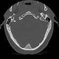 Cervical flexion teardrop fracture with cord hemorrhage (Radiopaedia 32497-33454 Axial bone window 4).jpg