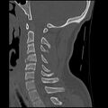 Cervical flexion teardrop fracture with cord hemorrhage (Radiopaedia 32497-33454 Sagittal bone window 25).jpg
