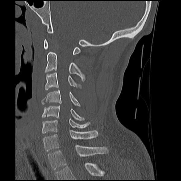 File:Cervical flexion teardrop fracture with cord hemorrhage (Radiopaedia 32497-33454 Sagittal bone window 25).jpg