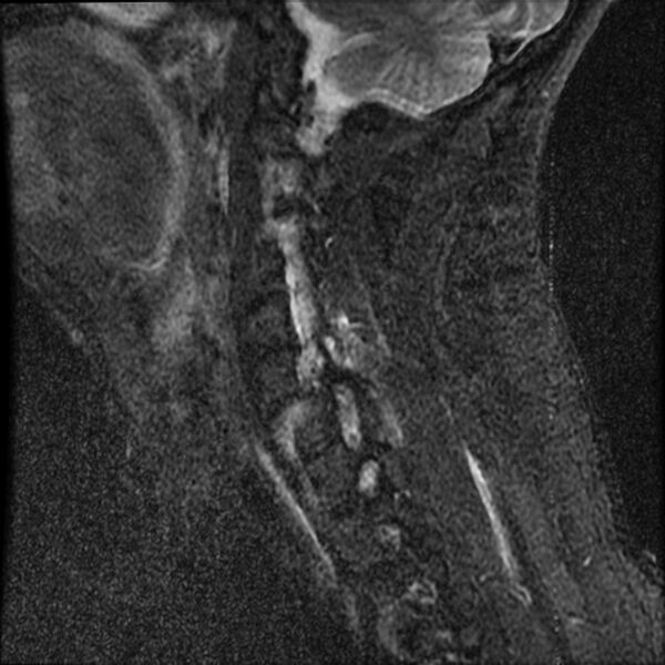 File:Cervical fracture and dislocation with locked facet (Radiopaedia 31837-32781 Sagittal STIR 5).jpg