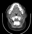 Cervical lymphadenopathy- cause unknown (Radiopaedia 22420-22457 non-contrast 32).jpg