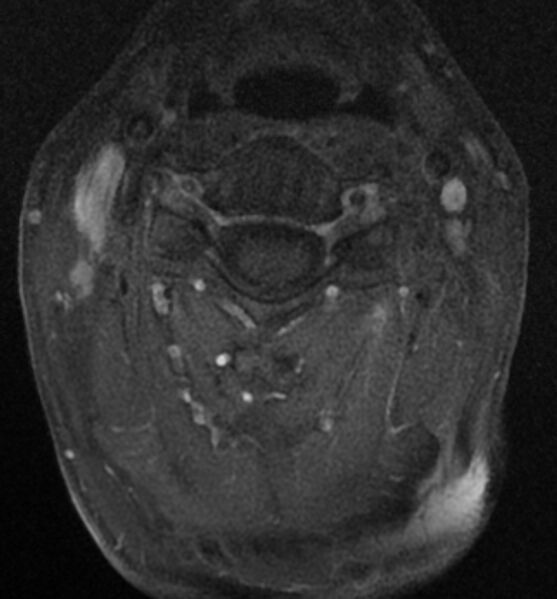 File:Cervical spondylodiscitis (Radiopaedia 81362-95110 Axial T1 C+ fat sat 6).jpg