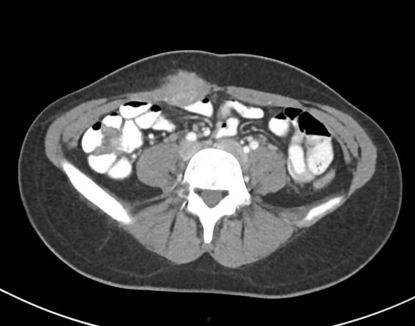 Cesarean scar endometriosis (Radiopaedia 82925-97262 A 54).jpg