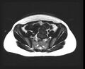 Cesarean section scar endometrioma (Radiopaedia 56569-63297 Axial T1 16).jpg