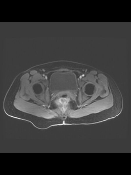 File:Cesarean section scar endometrioma (Radiopaedia 56569-63297 Axial T1 C+ fat sat 10).jpg