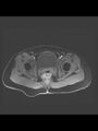 Cesarean section scar endometrioma (Radiopaedia 56569-63297 Axial T1 C+ fat sat 10).jpg