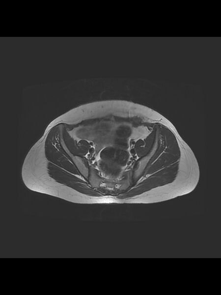 File:Cesarean section scar endometrioma (Radiopaedia 56569-63297 Axial T2 9).jpg