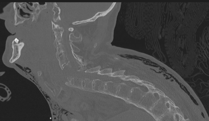 Chalk stick fracture (Radiopaedia 57948-64928 Sagittal bone window 26).png