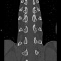 Chance fracture (Radiopaedia 36521-38081 Coronal bone window 42).jpg