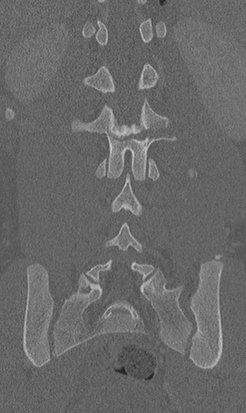 File:Chance fracture (Radiopaedia 40360-42912 Coronal bone window 47).png