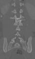Chance fracture (Radiopaedia 40360-42912 Coronal bone window 47).png