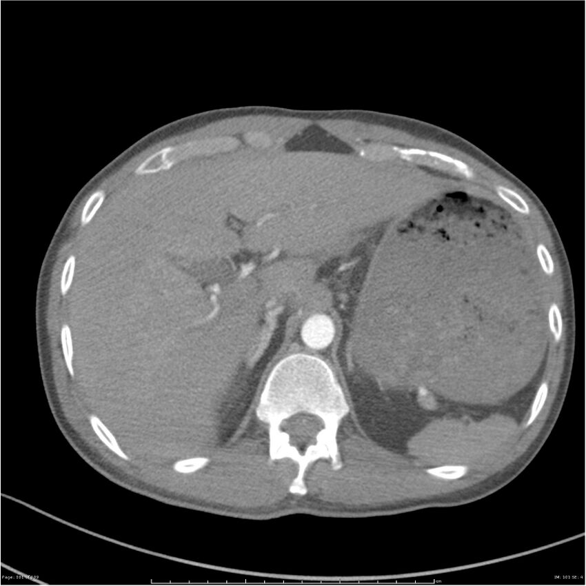 Chest and abdomen multi-trauma (Radiopaedia 26294-26425 A 101).jpg