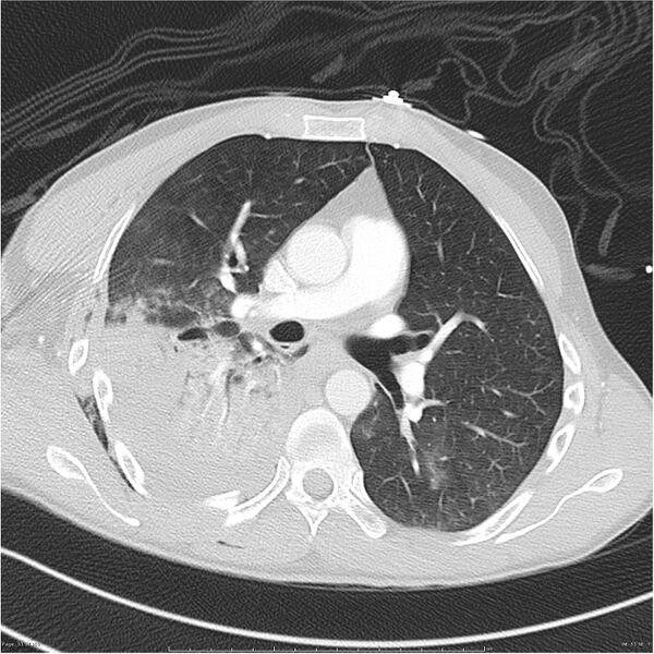 File:Chest and abdomen multi-trauma (Radiopaedia 26294-26425 lung window 51).jpg