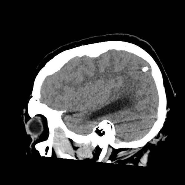 File:Chiasmatic-hypothalamic juvenile pilocytic astrocytoma (Radiopaedia 78533-91237 B 47).jpg