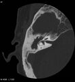 Cholesteatoma (Radiopaedia 5467-7197 Axial bone window 7).jpg
