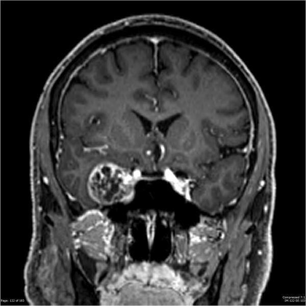 File:Chondrosarcoma of skull base- grade II (Radiopaedia 40948-43654 Coronal T1 C+ 33).jpg