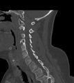 Chordoma (C4 vertebra) (Radiopaedia 47561-52188 Sagittal bone window 33).png