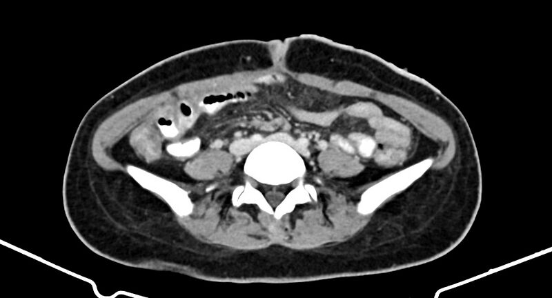File:Choriocarcinoma liver metastases (Radiopaedia 74768-85766 A 136).jpg