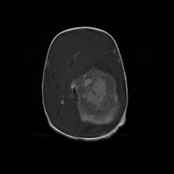 File:Choroid plexus carcinoma (Radiopaedia 21121-21035 Axial T1 C+ 11).jpg