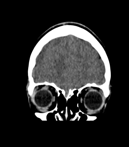 File:Choroid plexus carcinoma (Radiopaedia 91013-108552 Coronal non-contrast 15).jpg