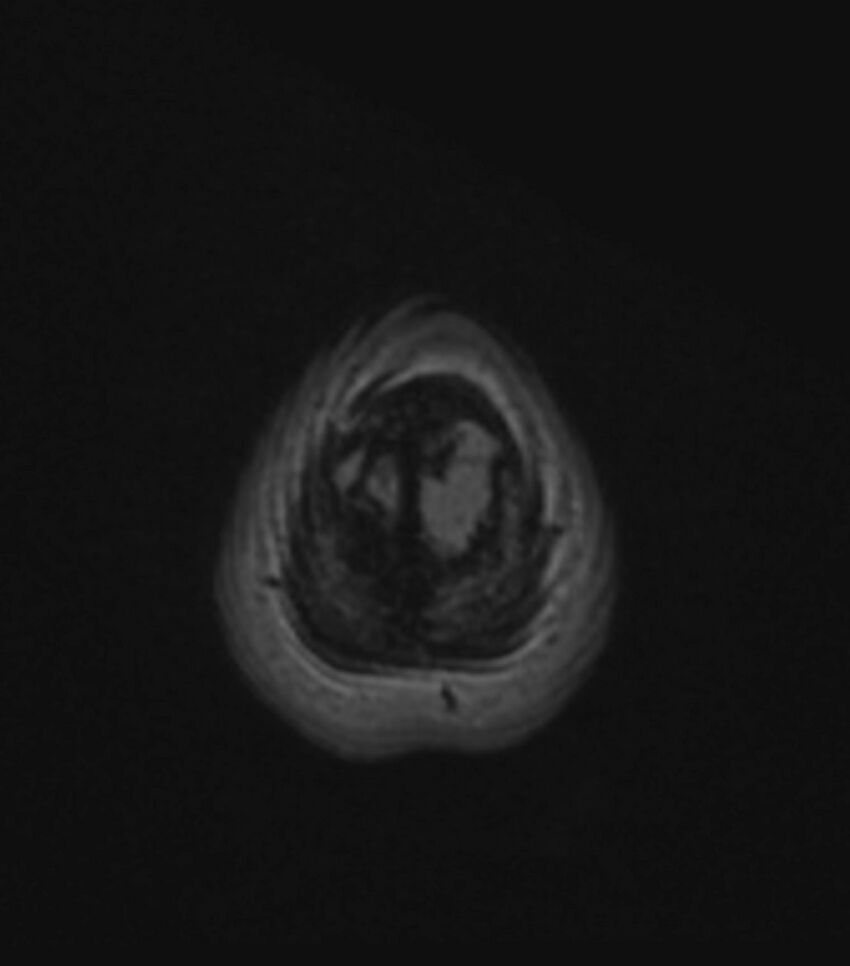Choroid plexus carcinoma (Radiopaedia 91013-108553 Axial FLAIR C+ 200).jpg