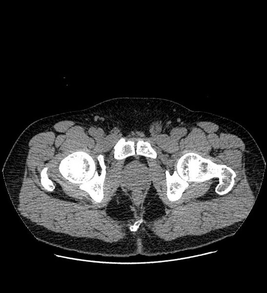 File:Chromophobe renal cell carcinoma (Radiopaedia 84337-99693 Axial non-contrast 161).jpg