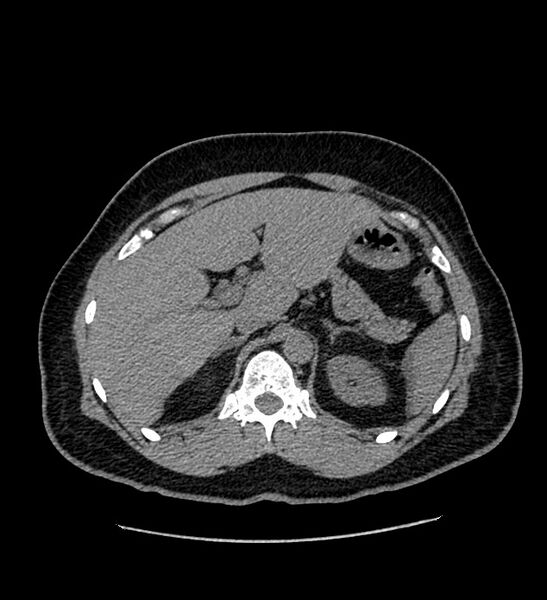 File:Chromophobe renal cell carcinoma (Radiopaedia 84337-99693 Axial non-contrast 33).jpg