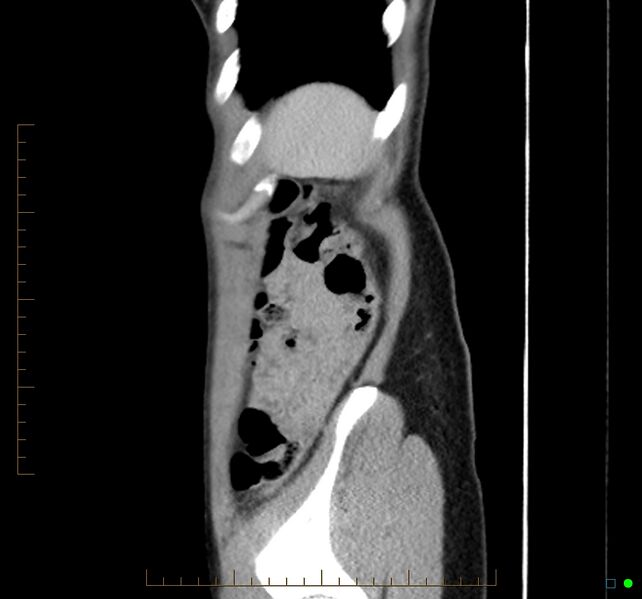 File:Chronic abscess due to "dropped" appendicoliths following appendectomy for perforated appendix (Radiopaedia 58805-66344 D 8).jpg