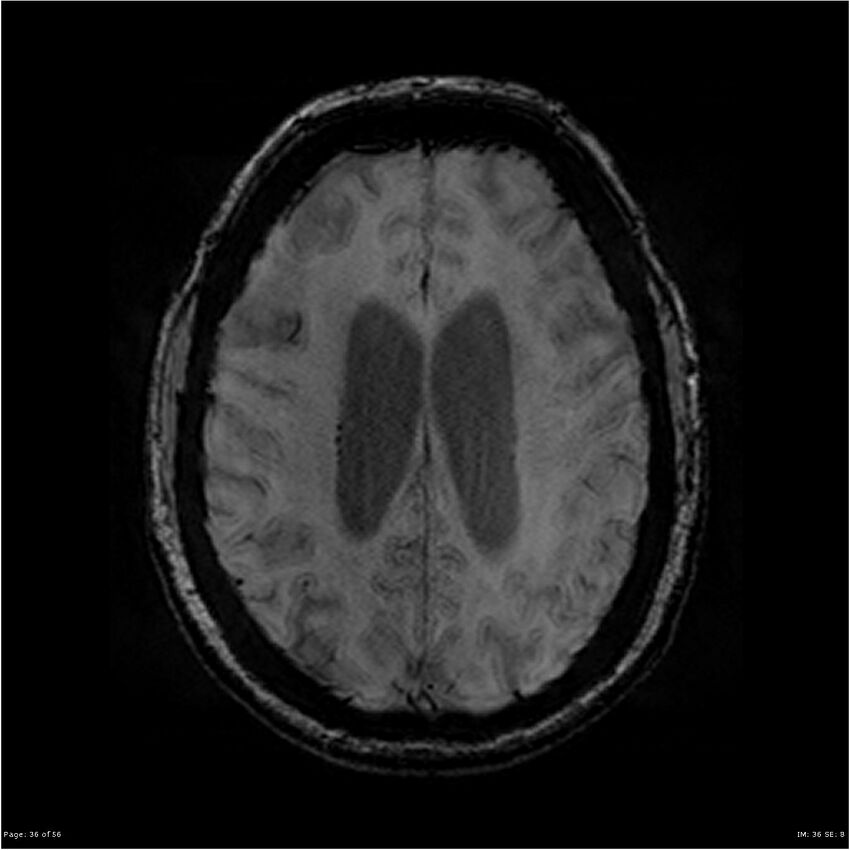 Chronic hypertensive encephalopathy (Radiopaedia 25764-25918 Axial SWI 36).jpg